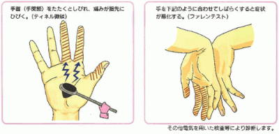 carpal_tunnel_syndrome_03